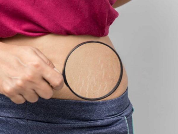 Naravno sredstvo v boju proti strijam